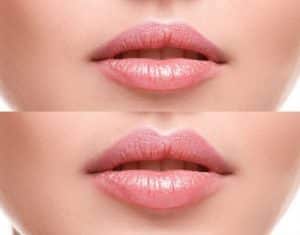 medical spa rx How to Create the Perfect Lip Shape Using Dermal Fillers