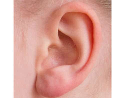 Tips for Remodeling the Ear: Concerns