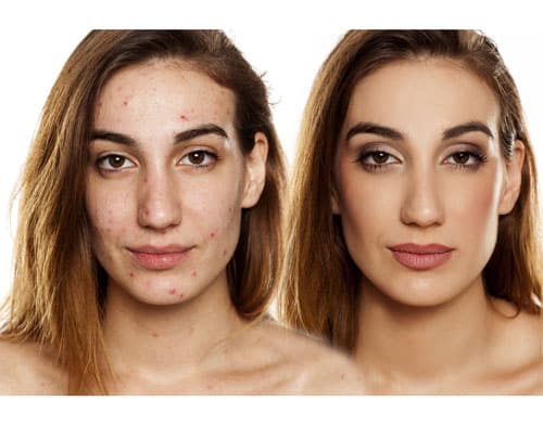Professional Tips: Treat Acne Scarring with Dermal Fillers Introduction