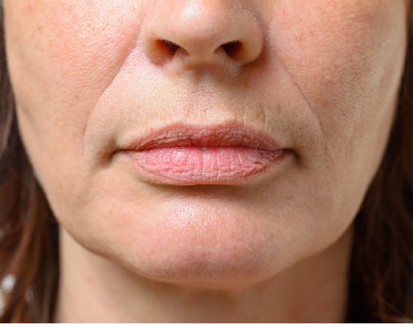 How to Treat the Perioral Area
