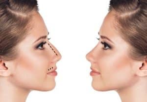 Nonsurgical Rhinoplasty: What You Need to Know
