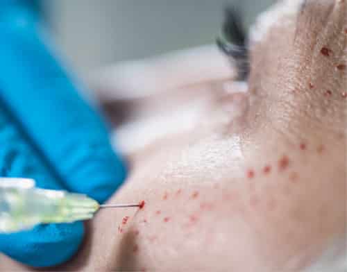 medical spa rx What Is Platelet-Rich Plasma Treatment?