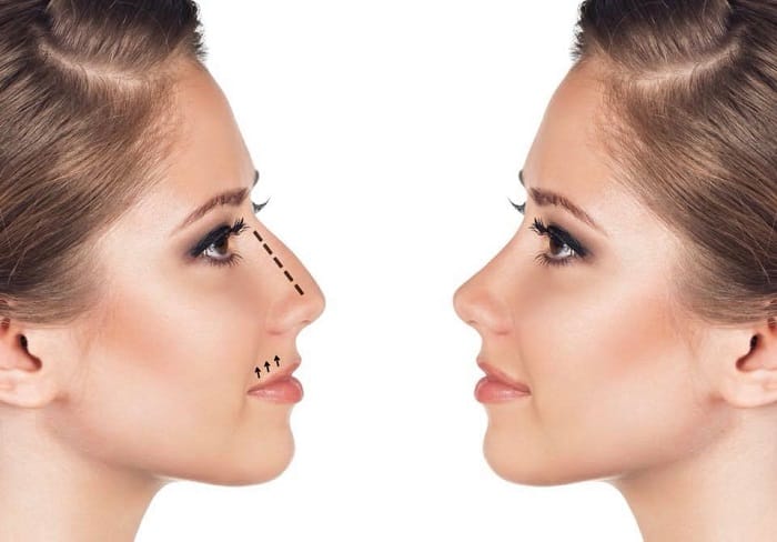 medical spa rx Nonsurgical Rhinoplasty: What You Need to Know