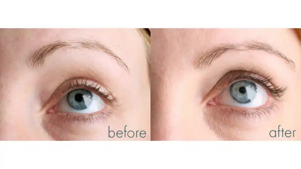 A patient's before and after photos of their Revitalash treatment for their brows and lashes.