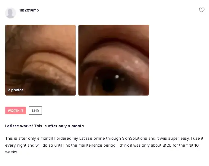 A patient shares a Latisse before and after photo of their lash after a month of use.