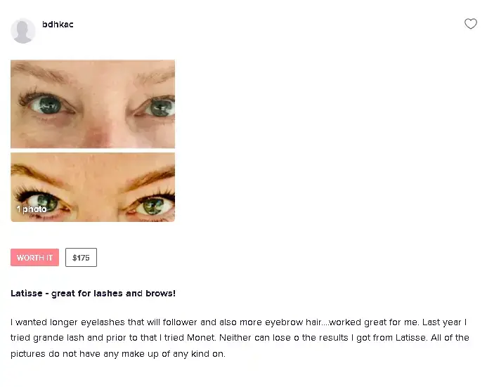 A patient's before and after photos of their Latisse treatment, showing fuller and darker lashes.