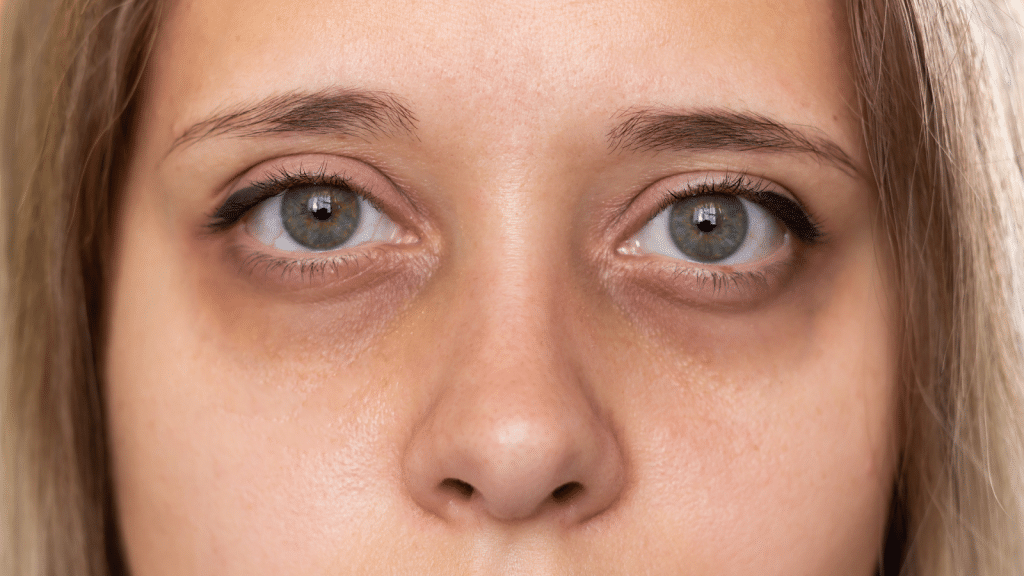 Close-up of a person's face showing eyes with dark circles, light skin, and blonde hair. The image highlights the eye area, including lashes and eyebrows, capturing an expressionless gaze.