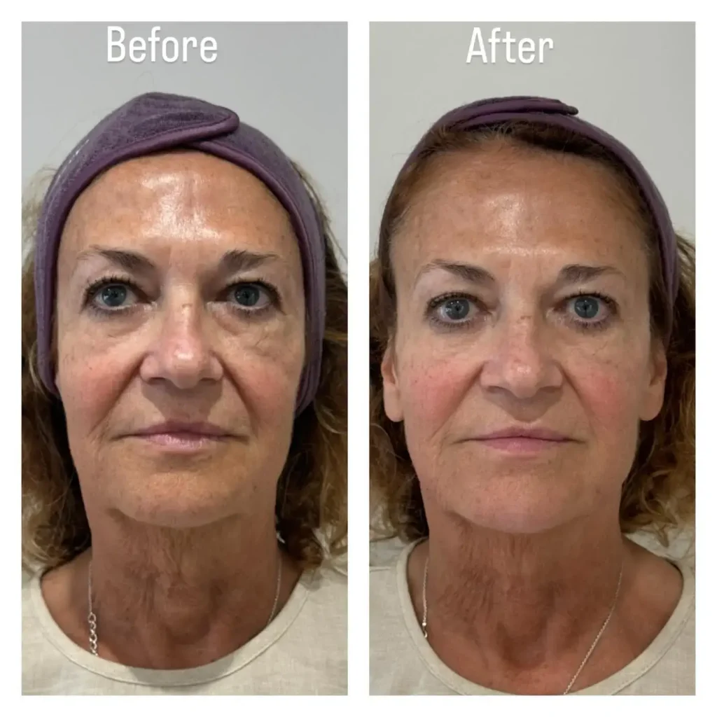 Before and after results with Harmonyca for facial contouring and rejuvenation