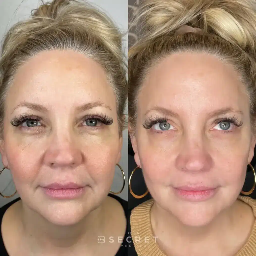 Sculptra before and after comparison