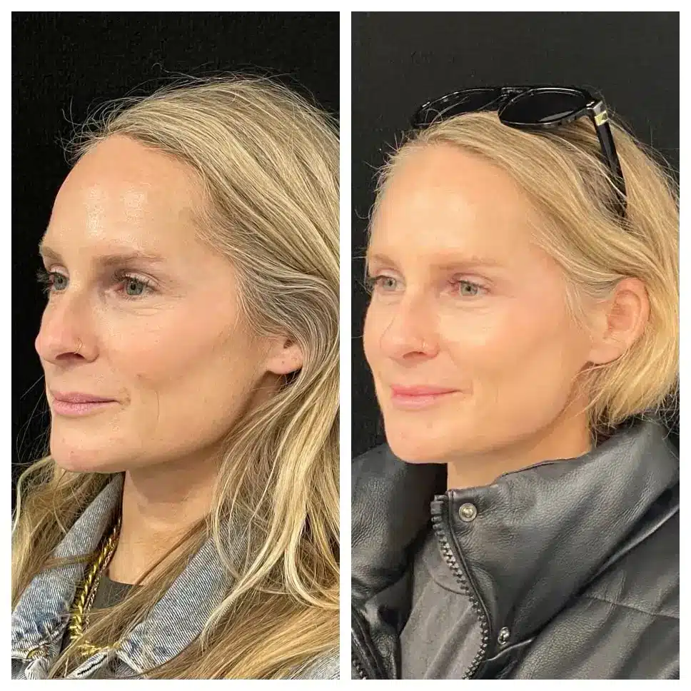 Before and after results with Radiesse