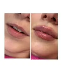 poutier lips after