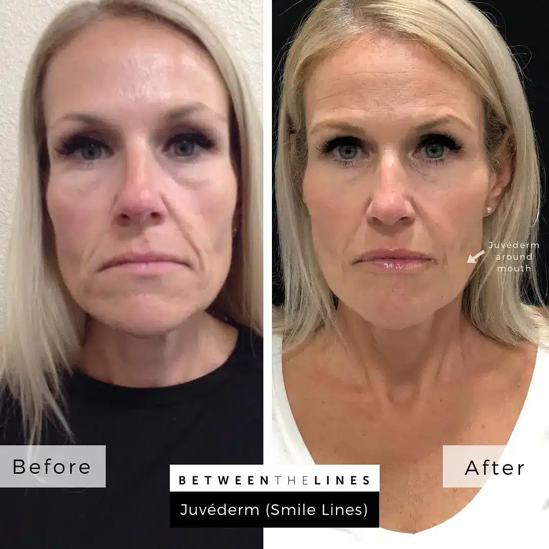 before and after dermal filler treatment