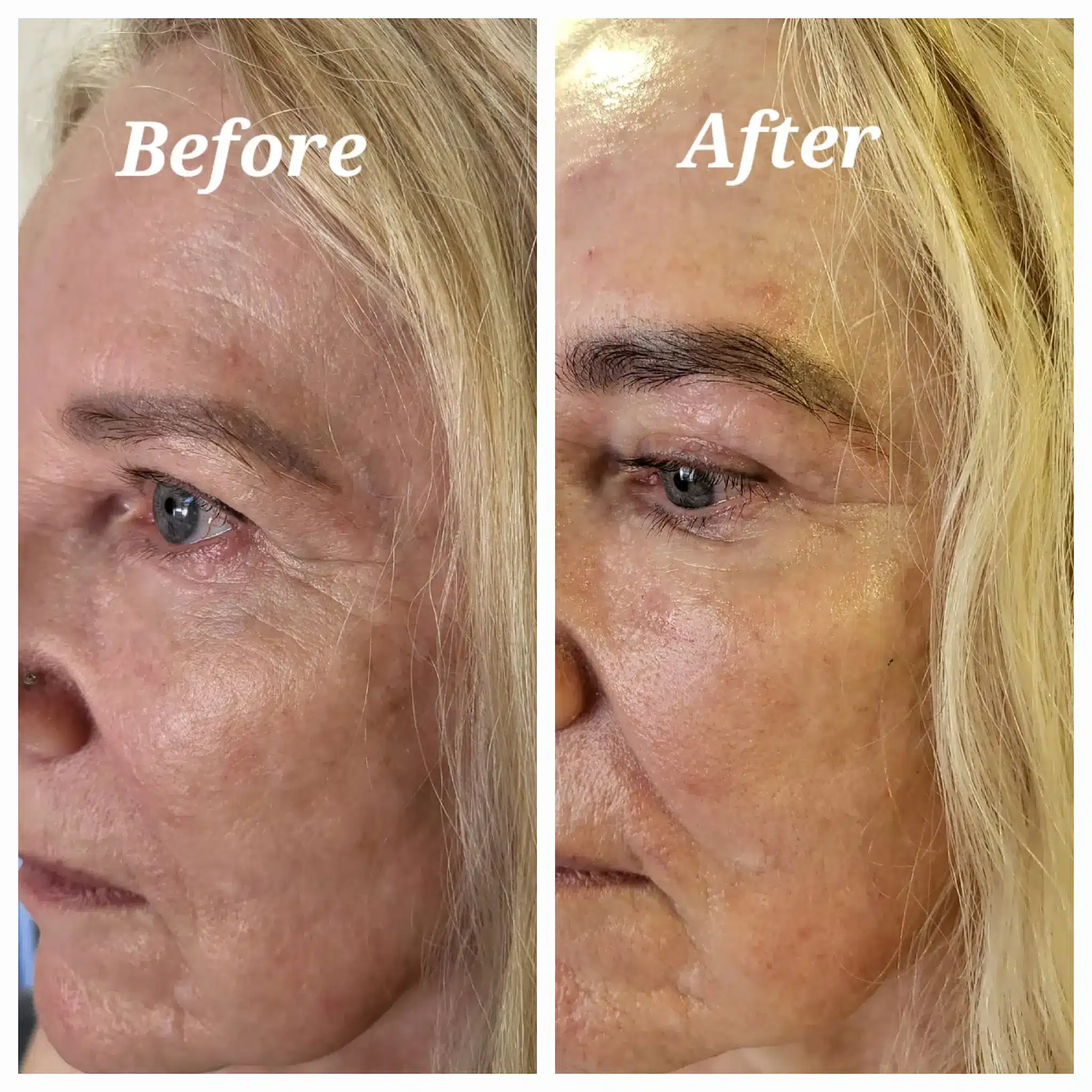 before and after Plasmolifting treatment