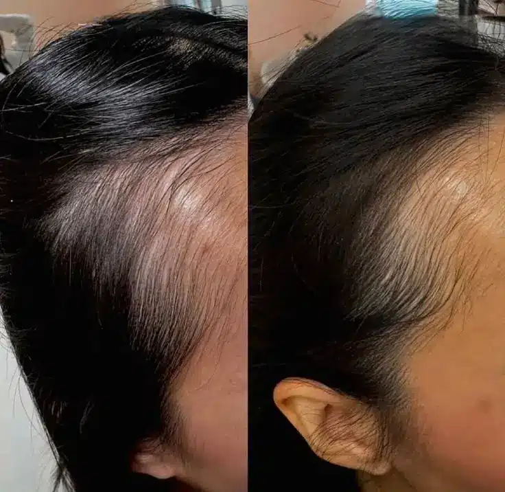 bafore and after hair regrowth treatment