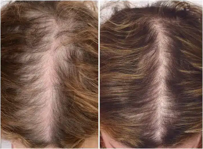 hair before and after PRP