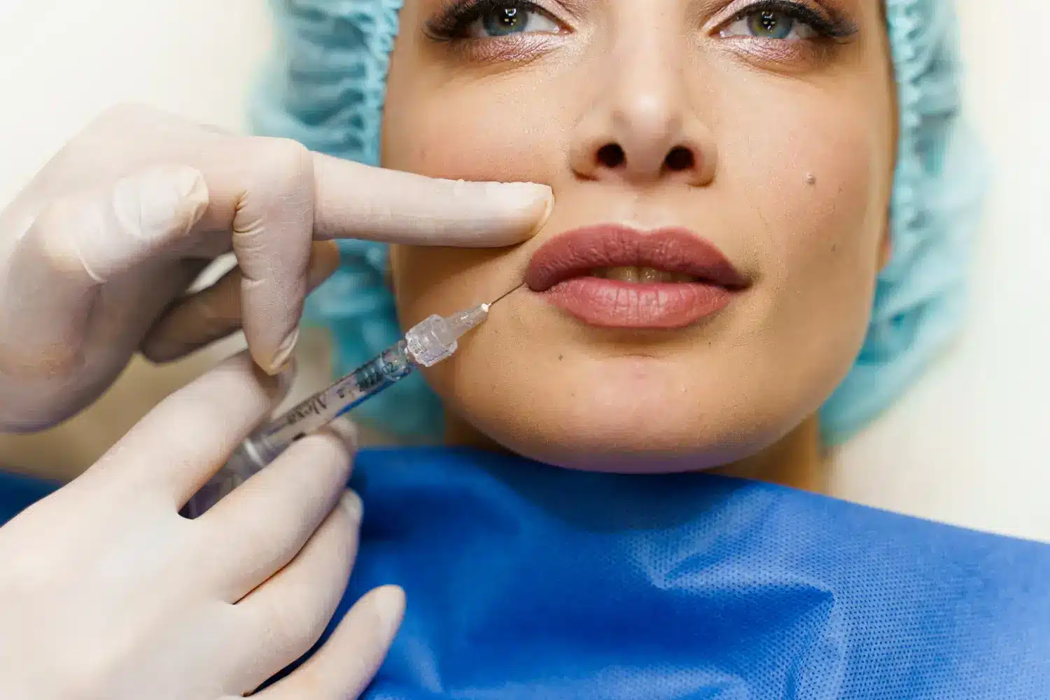 Close-up of lip augmentation treatment.