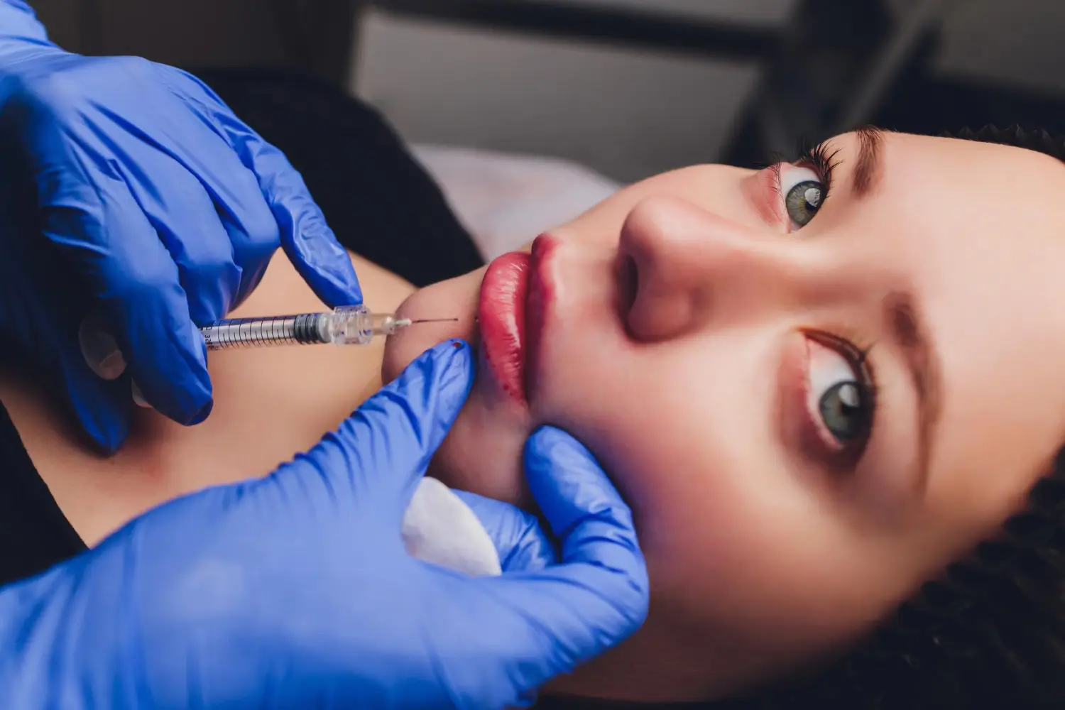 lip augmentation procedure