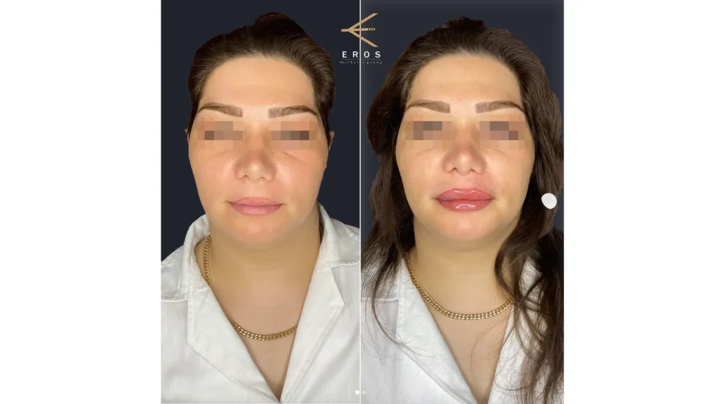 before and after results of Bellast filler