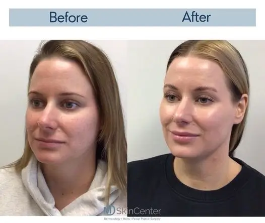 before and after results of Juvederm treatment