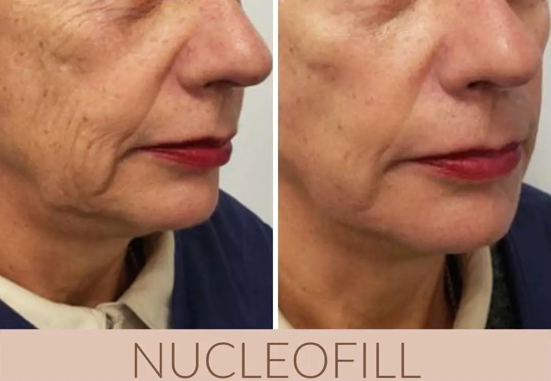 her nasolabial folds