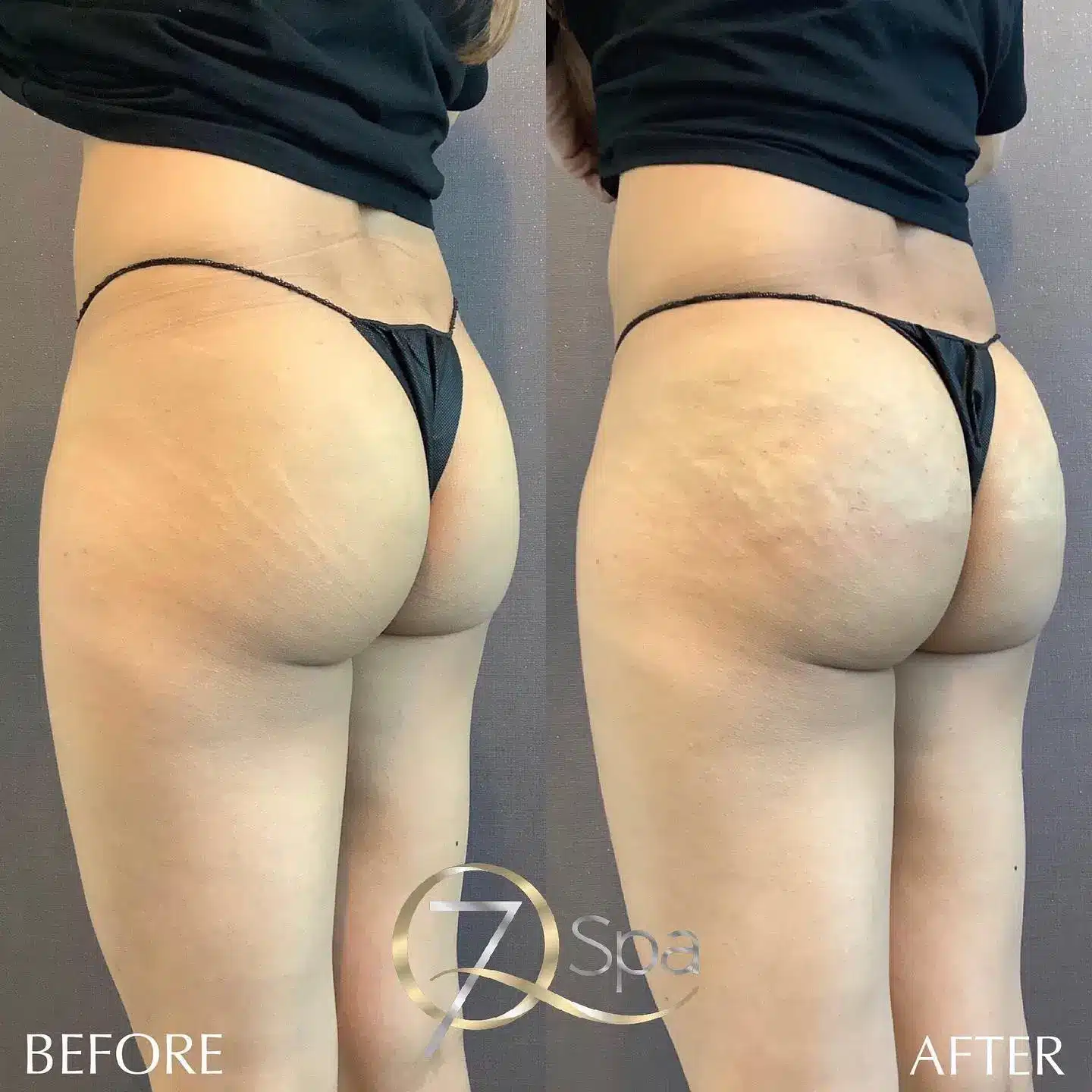 before and after buttock augmentation