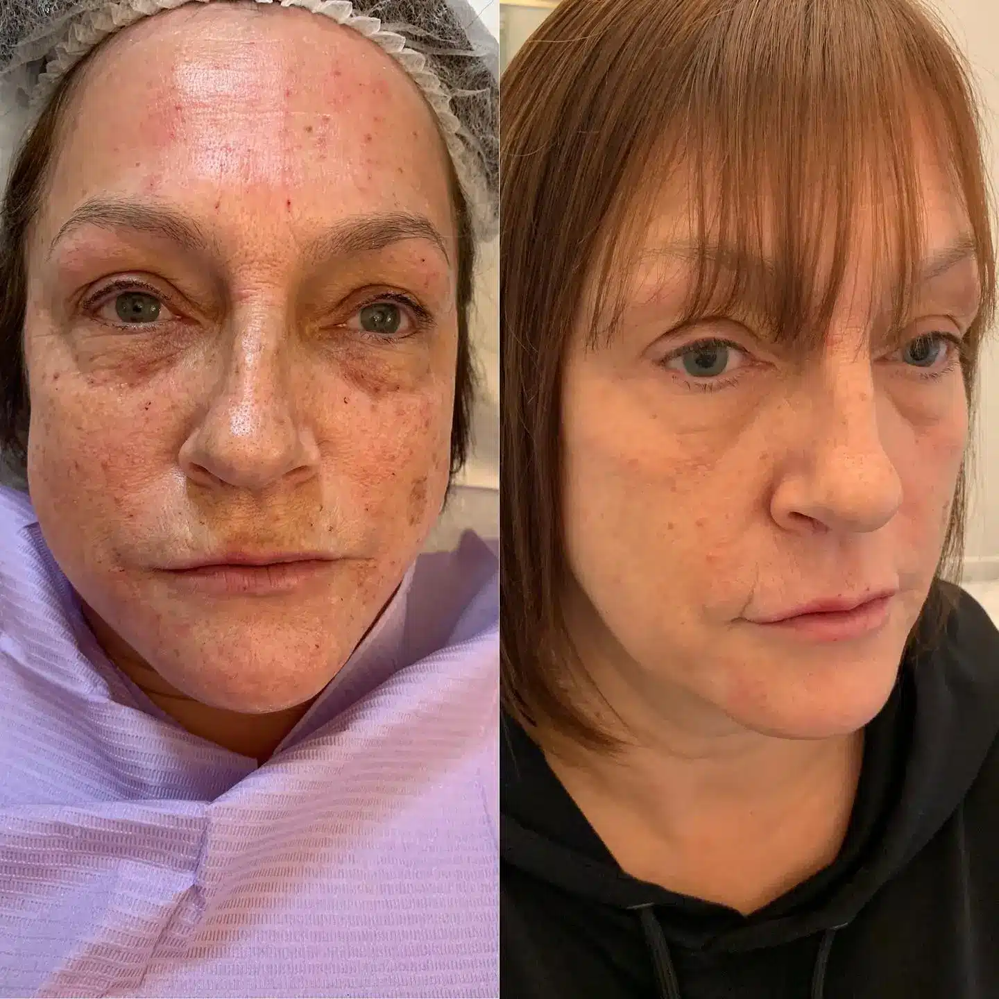 before and after face rejuvenation