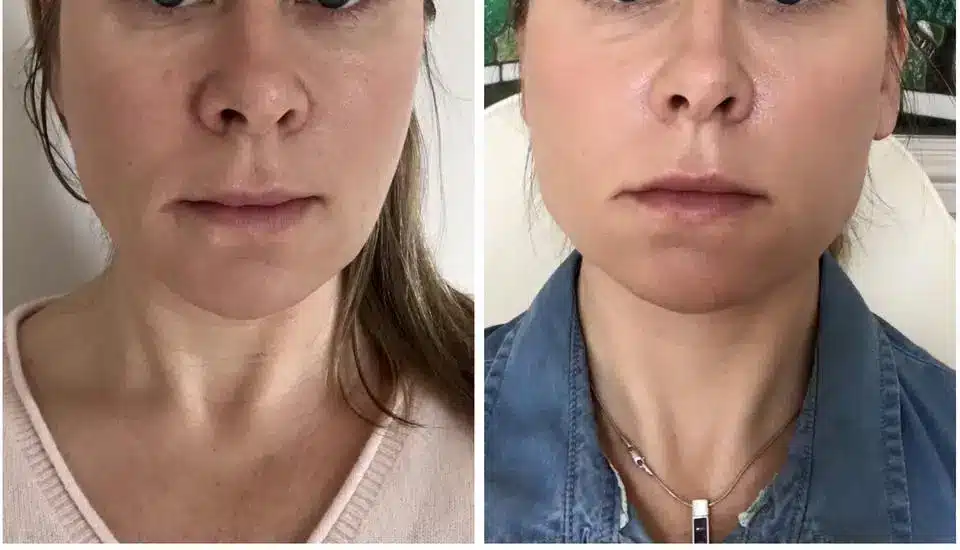 before and after her neck rejuvenation