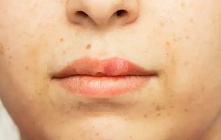 swelling lips