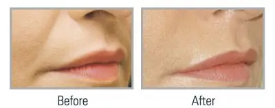 lip enhancement