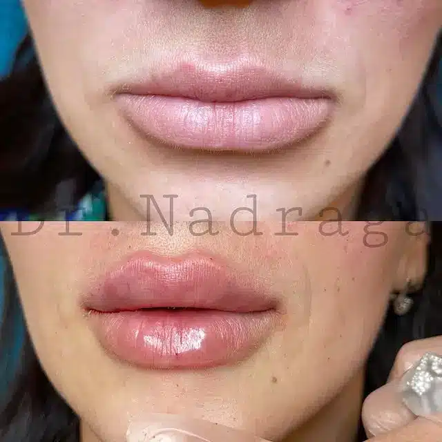 Perfectha Lip Filler Before and After With Photos 3