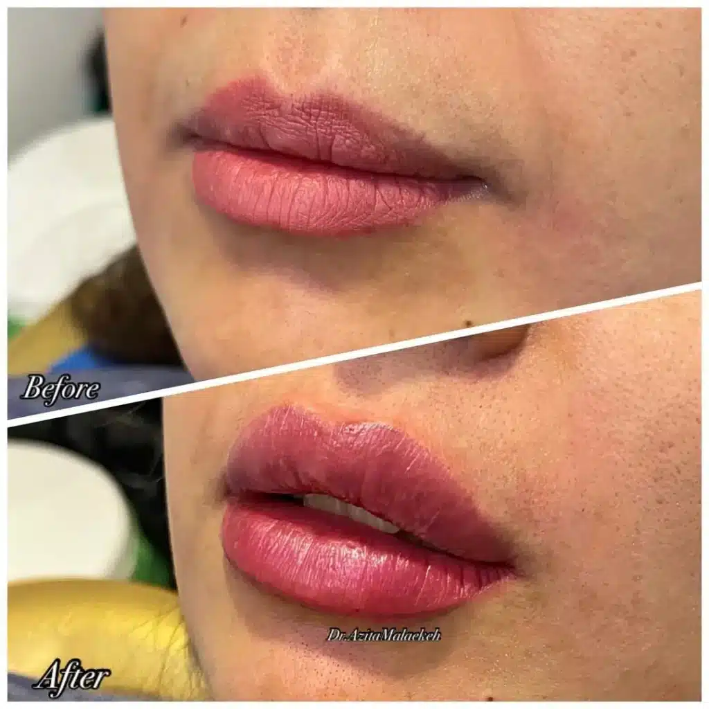 Perfectha Lip Filler Before and After With Photos 4