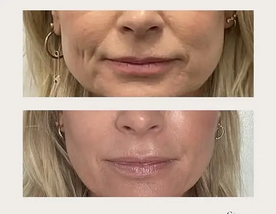 Viscoderm Hydrobooster Before and After Visible Improvements in Skin Quality 1